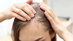 נשירת שיער נערות